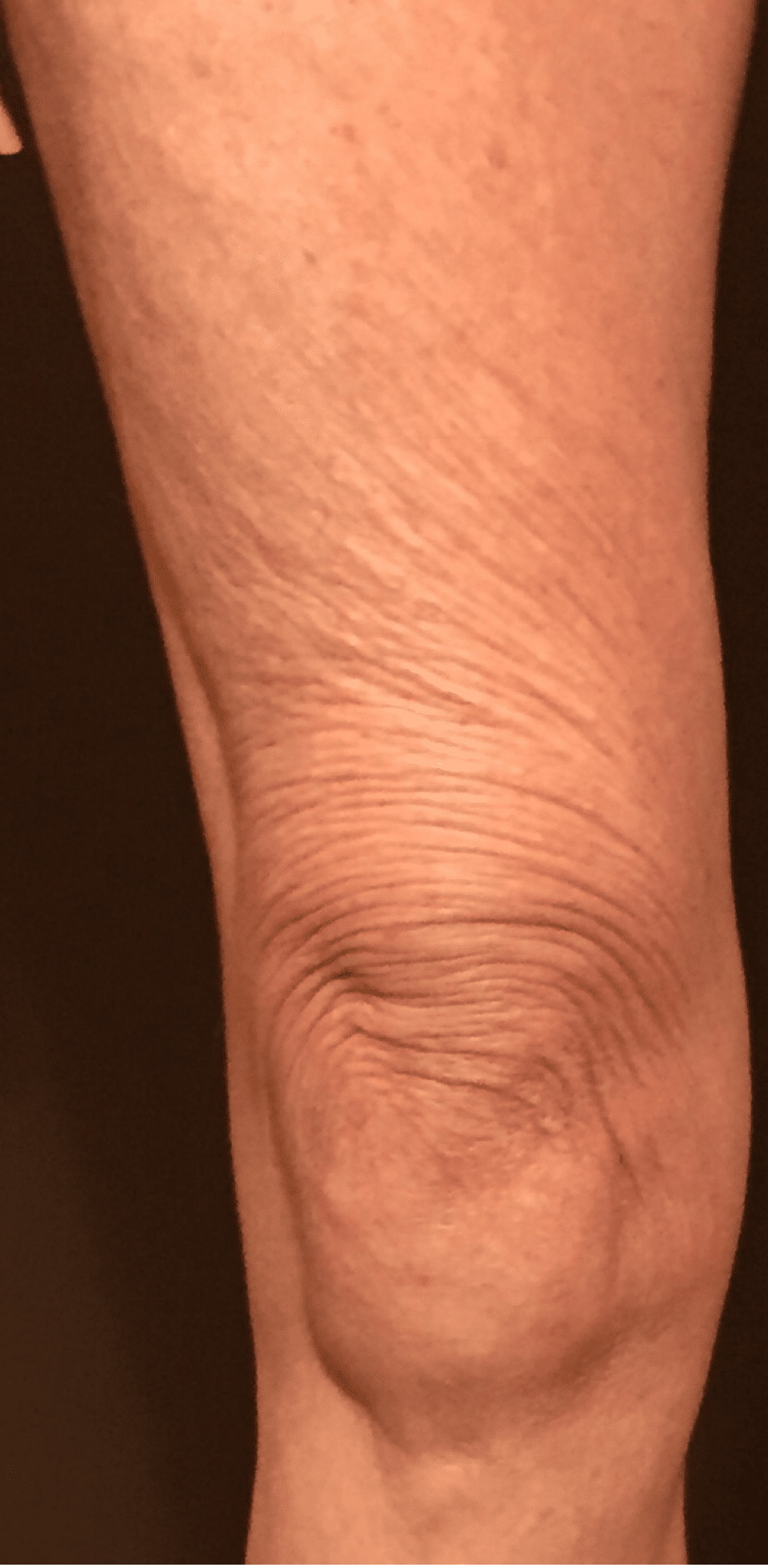 Thermi Tight | Thermi Smooth Westborough MA | Worcester MA Thermi Tight | Thermi Smooth Westborough MA | Worcester MA