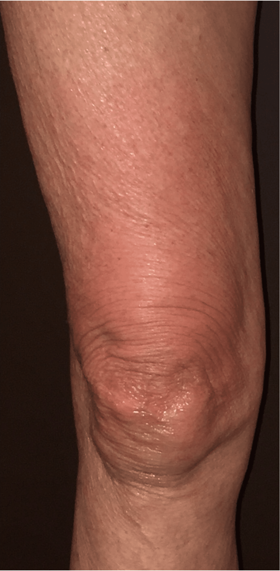 Thermi Tight | Thermi Smooth Westborough MA | Worcester MA Thermi Tight | Thermi Smooth Westborough MA | Worcester MA