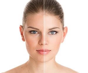Dermal Fillers Boston MA | Face Fillers Westborough | Worcester Dermal Fillers Boston MA | Face Fillers Westborough | Worcester